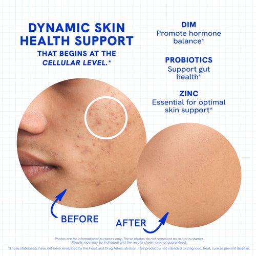 Clear Your Skin with DIM, Probiotics & Zinc