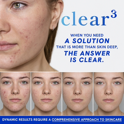 Clear Your Skin with DIM, Probiotics & Zinc