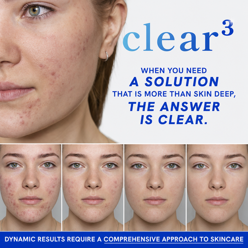 Clear Your Skin with DIM, Probiotics & Zinc